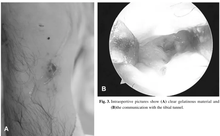 Fig. 3. Intraopertive pictures show (A) clear gelatinous material and (B)the communication with the tibial tunnel.