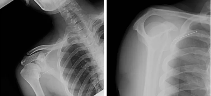 Fig. 1. Preoperative radiograph of the right shoulder. The radiograph shows an abnormal appearance of lesser tuberosity (arrow)
