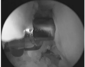 Fig. 4. Posterolateral aspect of the coracoid process after cora- cora-coplasty using a 4.0 mm burr through the anterolateral portal.