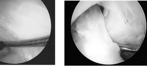 Fig. 2. Second look arthroscopy of 40 year old male who had undergone double bundle ACL reconstruction; AM  bun-dle with no laceration or elongation with sufficient thickness and completely covered synovium, PL bundle with partial laceration and synovial c