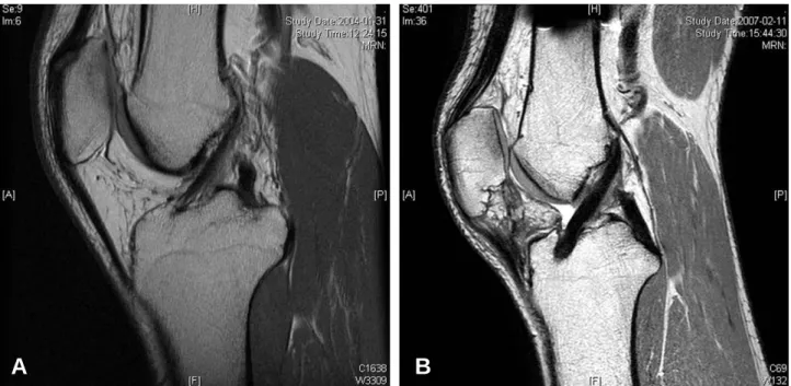 Fig. 4. Sagittal MRI scans of the individual groups show that the Achilles graft(B) was aligned more horizontally than the native ACL(A)