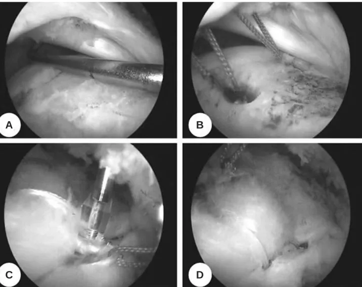 Fig. 1. (A) A medium-sized cuff tear from posterolateral portal in right shoulder. (B) The medial-row anchors are placed immediately lateral to the articular surfaces
