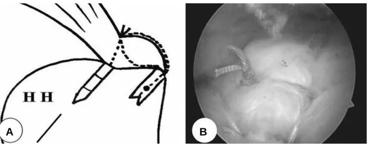 Fig. 2. (A) A Schematic drawing shows the repair construct (HH : Humeral head). (B) Arthroscopic photograph shows good tissue