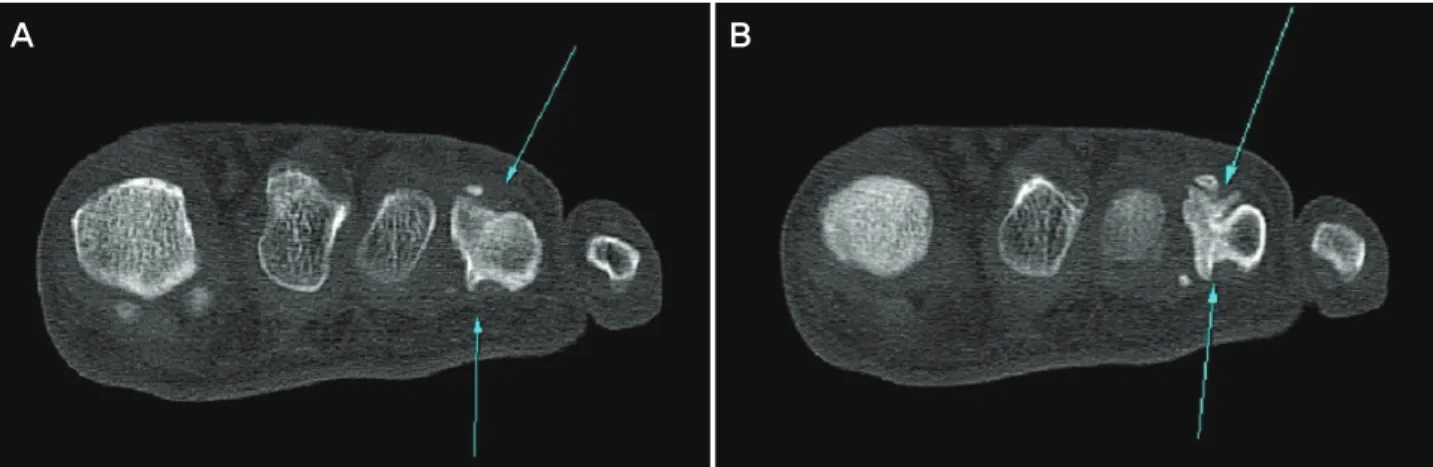 Figure  2.  Axial  CT  shows  connection  of  the  medulla  and  the  cortex  of  the  lesion.