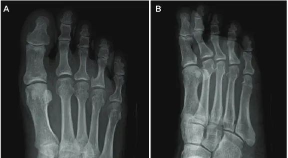 Figure  5.  Postoperative  AP  and  oblique  radiographs  of  the  right  foot  show  little  remnant  of  the  lesion  but  the  third  webspace  is  normalized  comparing  to  the  others.