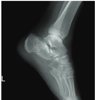Figure  2.  Preoperative  CT  reveals  Sanders  type  IIIAC  on  coronal  plane.