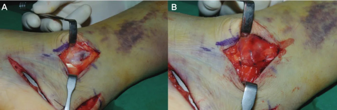 Figure  6.  Preoperative  CT  reveals  peroneal  tendon  dislocation.