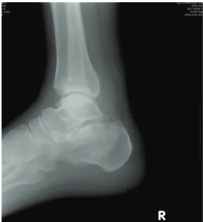 Figure  10.  (A)  Preoperative  CT  reveals  peroneal  tendon  dislocation.  (B)  Postoperative  CT  reveals  peroneal  tendon  dislocation.