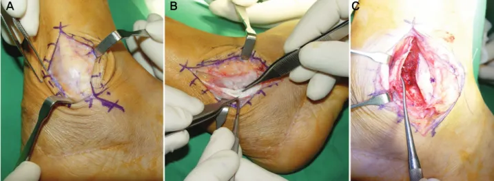 Figure  11.  (A)  Intraoperative  finding  shows  anterior  dislocation  of  peroneal  tendon