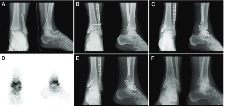 Figure  2.  (A)  Initial  and  (B)  postoperative  radiograph  of  a  53-year-old  man  who  had  Hawkins  type  III  talar  neck  fracture