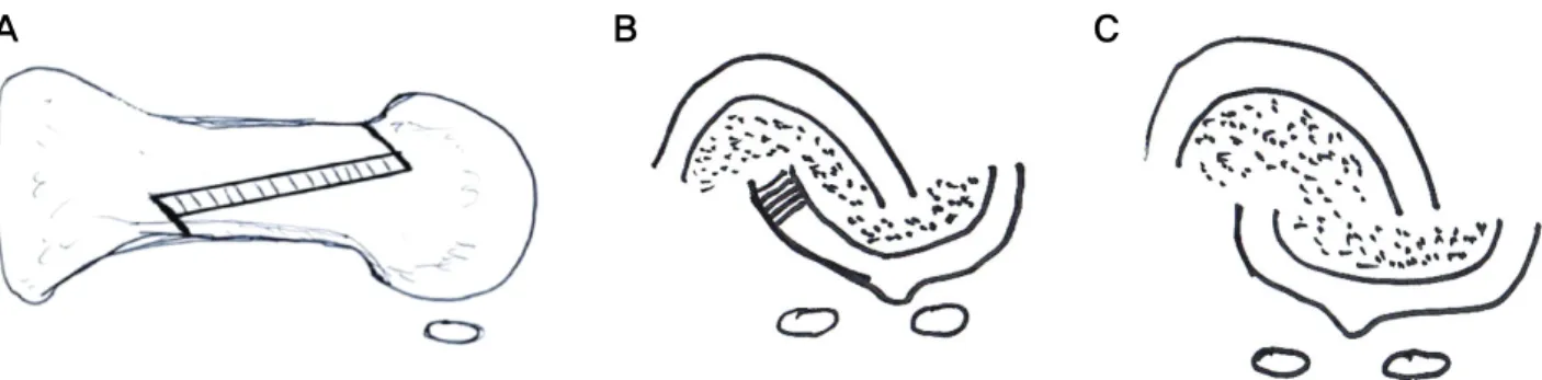 Figure  2.  Schematic  figures  of  longitudinal  cut  with  closing-wedge  osteotomy  from  medial  side  of  distal  osteotomy  fragment  in  sagittal  (A)  and  coronal  (B)  view