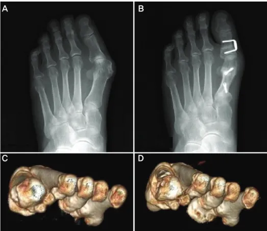 Figure  4.  Plain  weight  bearing  anteroposterior  radiographs;  Preop  (A)  and  Postop  (B)  and  3-  dimensional  CT;  Preop  (C)  and  Postop  (D)  shows  improved  hallux  valgus  angle,  first-second  intermetatarsal  angle  and  supination  of  th