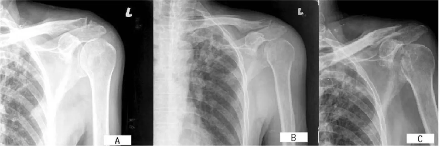 Fig. 1. Simple Shoulder AP and Axial view show normal findings preoperatively at first visit (A) and osteolytic lesion at the humeral head and glenoid with narrowed gleno-humeral joint space 2 month later preoperatively (B)