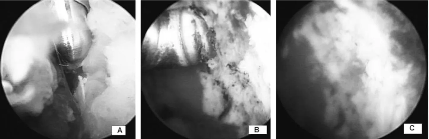 Fig. 4. Intraoperative Arthroscopic Findings show severe adhesion with synovial hyperplasia(A), cartilage defect on both glenoid (B) and humeral head (C).