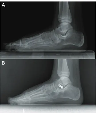 Figure  2.  (A)  Anteroposterior  preoperative  x-ray  in  standing  position. 
