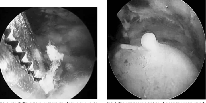 Fig. 1. The chalky material at formative phase is seen in the arthroscopic view.