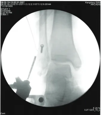 Figure  4.  Closed  reduction  and  internal  fixation  with  lag  screw  using  arthroscopy  was  done  under  fluroscopy.