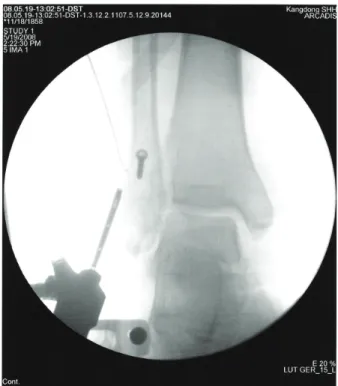 Figure  4.  Closed  reduction  and  internal  fixation  with  lag  screw  using  arthroscopy  was  done  under  fluroscopy.