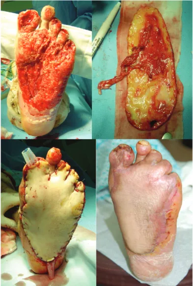Figure  3.  This  serial  clinical  photos  show  that  large  diabetic  foot  wound  with  exposure  of  ligament  and  tendon  can  be  managed  with  anterolateral  thigh  perforator  flap  successfully.