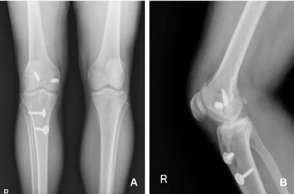 Fig. 2. Preoperative MRI showed poor tibial plateau bone stock. 