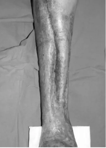 Fig. 6. Photograph shows the patient’s lower extremity after limb salvage procedures.