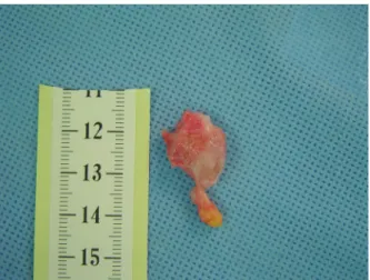Figure  1.  This  photograph  shows  pathologic  specimen  of  the  os  trigonum,  demonstrating  its  length  to  be  approximately  2  cm.