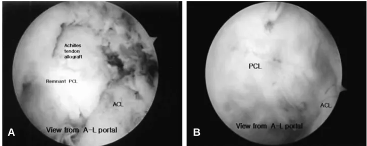 Fig. 2. (A) Immediate postoperative arthroscopic photograph view in the left knee  from A-L portal