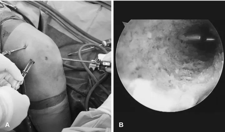 Fig. 7. The way to check the position of the cross pin at our institution (A) photographic view, (B) arthroscopic view.