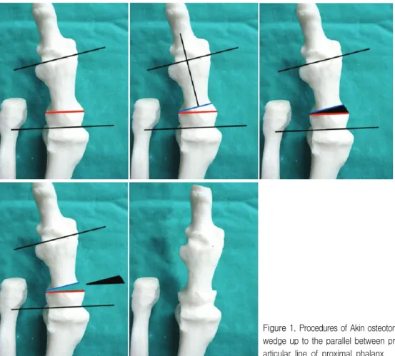 Figure  1.  Procedures  of  Akin  osteotomy.  Medial  closing  wedge  up  to  the  parallel  between  proximal  and  distal  articular  line  of  proximal  phalanx.