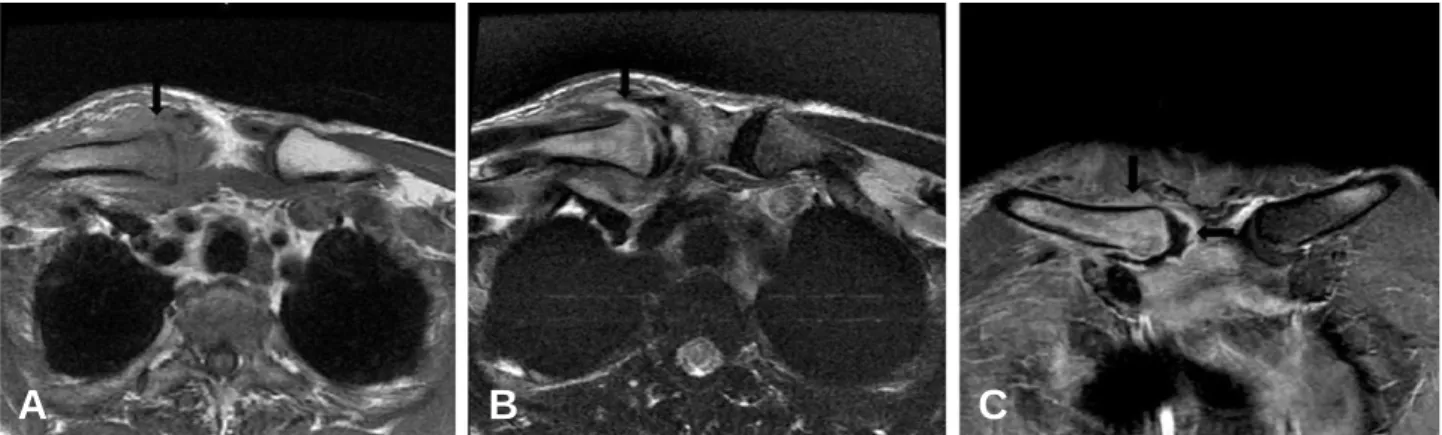 Fig. 1. A posteroanterior clavicular radiograph shows no specific findings.