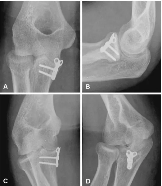 Fig. 4. (A-D) The postoperative radiographs show anatomical reduction and stable fixation of the coronoid process with a buttress plate.