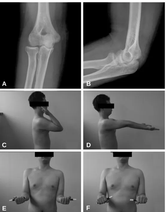 Fig. 5. (A, B) The anteroposterior and lateral radiographs after removal of the implant at 24 month after operation show good healing of the coronoid process