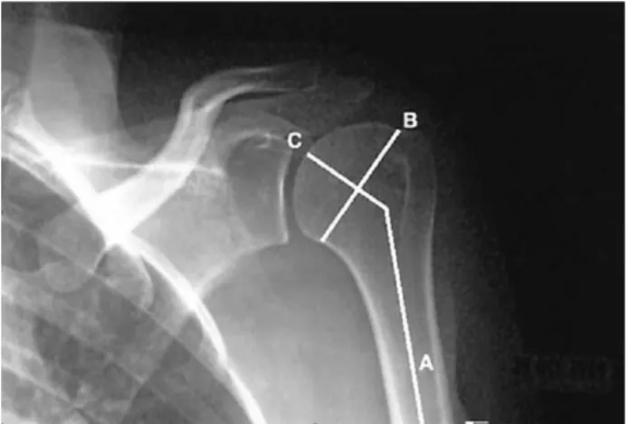 Fig. 1. Neck/shaft angle. By use of an anteroposterior radi- radi-ograph, the humeral neck/shaft angle was determined by the intersection of a line drawn on the central axis of the humeral shaft (A) with a line (C) drawn perpendicular to the anatomic neck 
