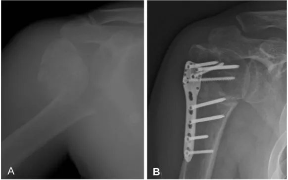 Fig. 6. Fixation with locking compression plate in 3-part proximal humerus fracture (A) An anterior posterior radiograph was taken at immediate post operation