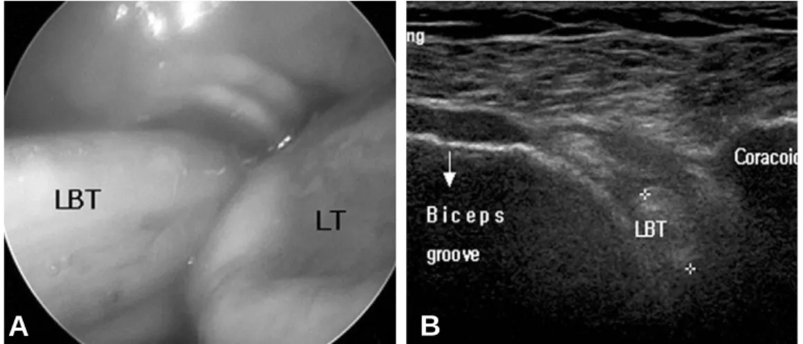 Fig. 1. (A) The biceps tendon is dislocated in arthroscopic finding, (B) The biceps tendon read as  ‘dislocation’in ultrasonography.