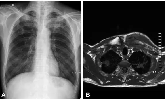 Fig. 2. Histologic finding. The study demonstrates focal caseous necrosis and Langerhans giant cell.
