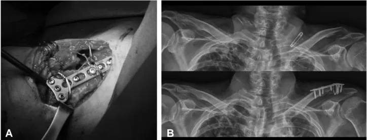 Fig. 2. Radiograph showing CA ligament augmentation with two double loaded 3.5 mm suture anchor inserted in coracoid process and fracture was fixed with 3.5 mm LCP.