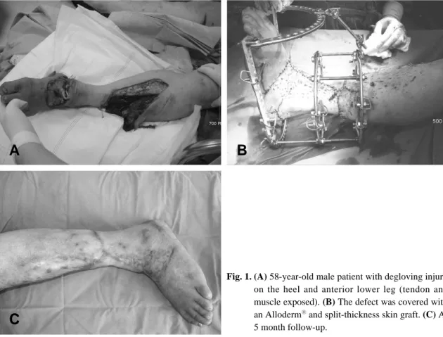 Fig. 1. (A) 58-year-old male patient with degloving injury on the heel and anterior lower leg (tendon and muscle exposed)