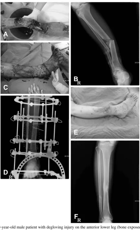 Fig. 2. (A), (B)19-year-old male patient with degloving injury on the anterior lower leg (bone exposed and tibia-fibular shaft fracture)