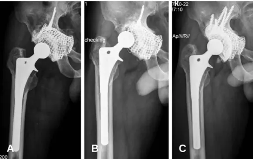 Fig. 3. (A) 29-year-old man underwent cup and stem revision using 5 allografts. (B) AP radiograph of postoperative 6 months shows cup loosening
