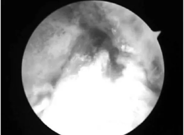 Fig. 3. After reconstruction of ACL, proper tension was felt by probe. and there was no impingement.