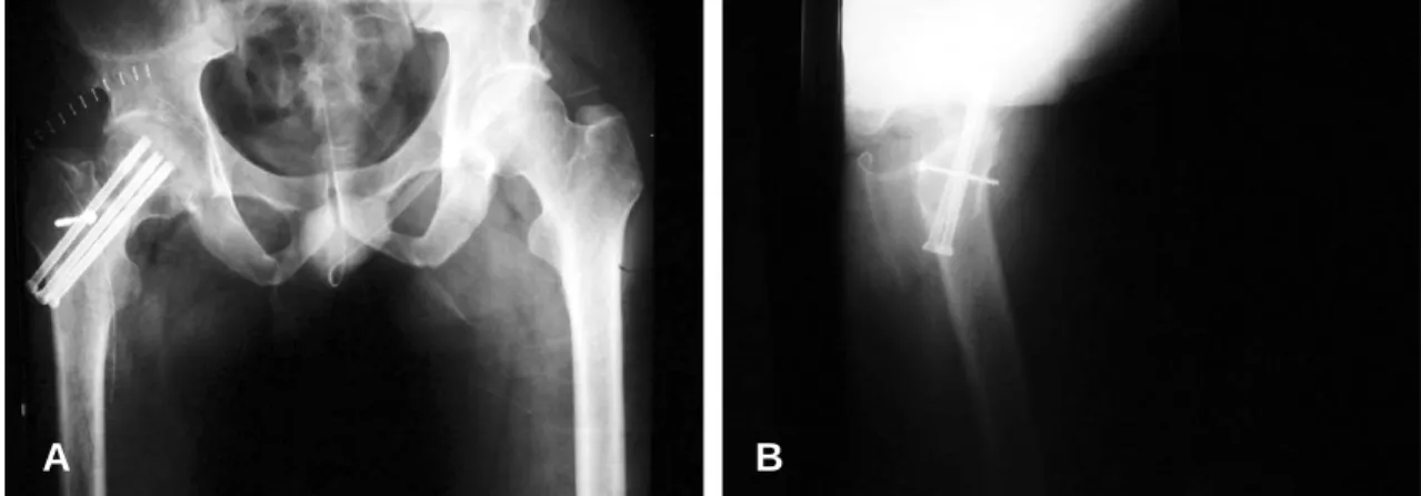 Fig. 4 (A) (B). Radiographs at the time of 24 months show callus formation and complete bone union.