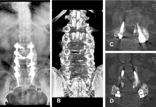 Fig. 1. At postoperative 22 months, anteroposterior radiograph (A), 3D reconstruction CT (B), and axial tomography (C),  (D) showed complete bone union in both intertransverse area grafted with hydroxyapatite on the right side and allogeneic bone on the le