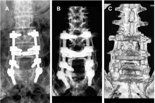 Fig. 2. Demineralized bone matrix mixed with autogenous iliac bone showed complete bone union in anteroposterior radiograph (A) and 3D reconstruction CT (B), (C) at postoperative 14 months.