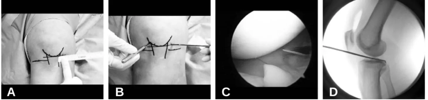 Fig. 2. (A) With the knee flexed to 30�, a horizontal line at the PIP level was drawn on the anterior joint line of tibia