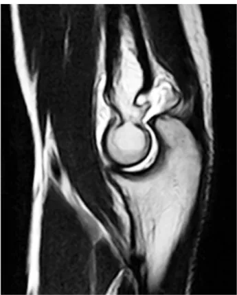 Fig. 3. 지속적인 투구 동작으로 후방 olecranon fossa에 골극 이 발생한 20세 남자 투수.