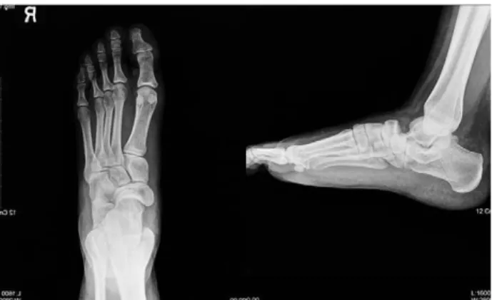 Fig. 1. This AP and lateral simple X-ray shows isolated talon- talon-avicular dislocation.