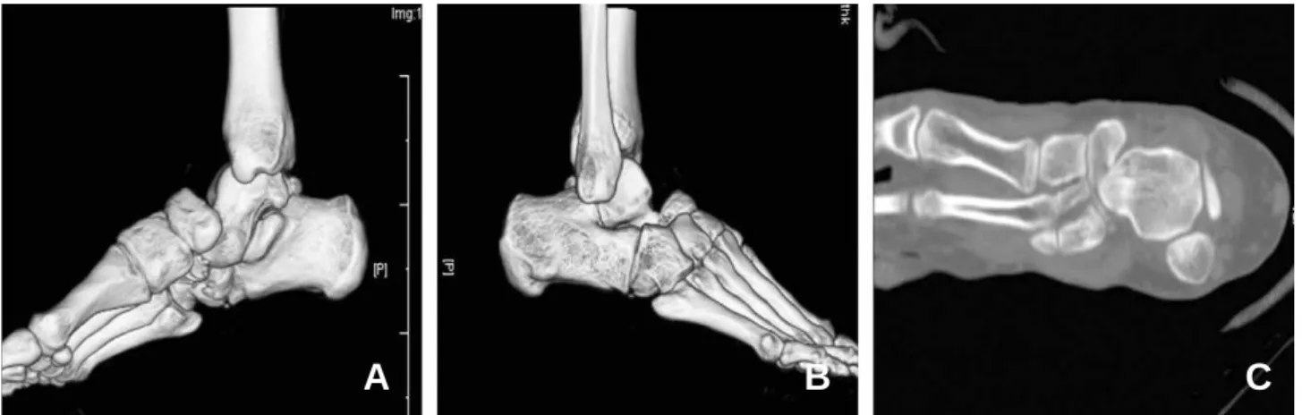 Fig. 3. Postoperative X-ray shows reduction of talonavicular