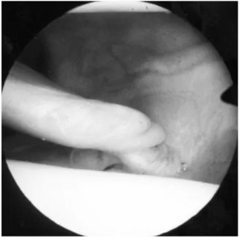 Fig. 4. The soft mass was a large pedunculated reddish brown lesion attached to the synovium of infrapatellar fat pad.