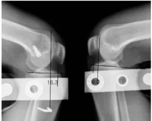 Fig. 3. Postoperative stress view shows 2.0 mm side-to-side difference with anterior drawer test.